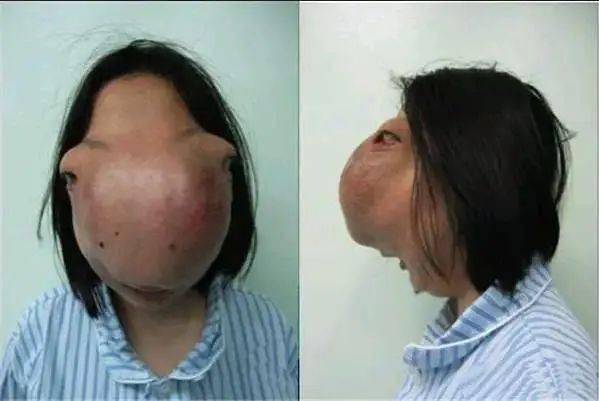 广州出现马脸女孩,因模样怪异蒙头生活14年,医生掀开盖帘也吓得当场