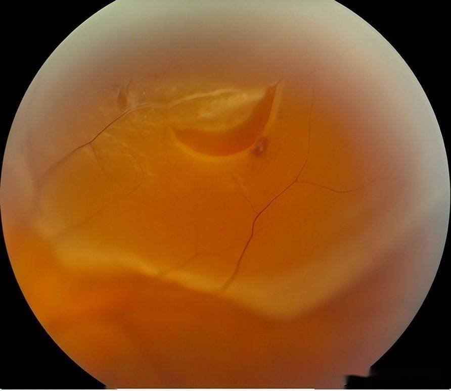 应及时到眼科进行详细的眼部检查;2)若为生理性的玻璃体混浊,无需过度