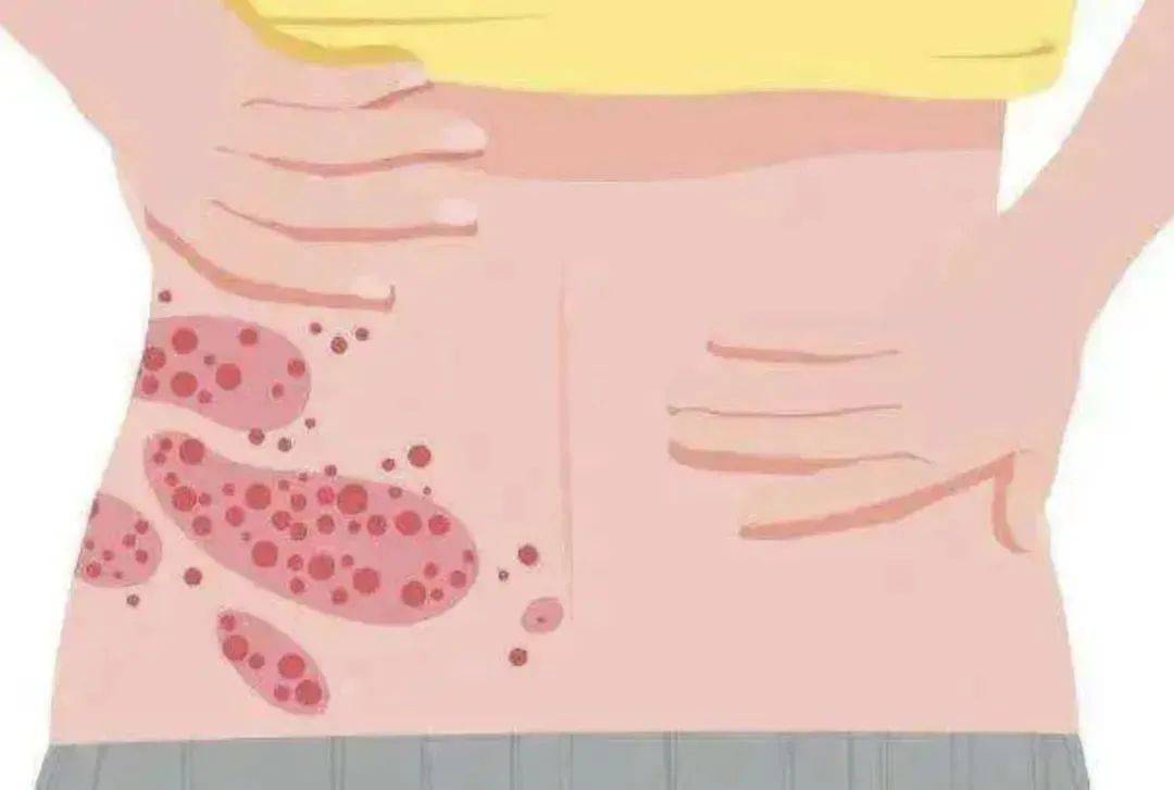 乡镇卫生院开具复课证明方可返校,如水痘症状较重或引起其他并发症