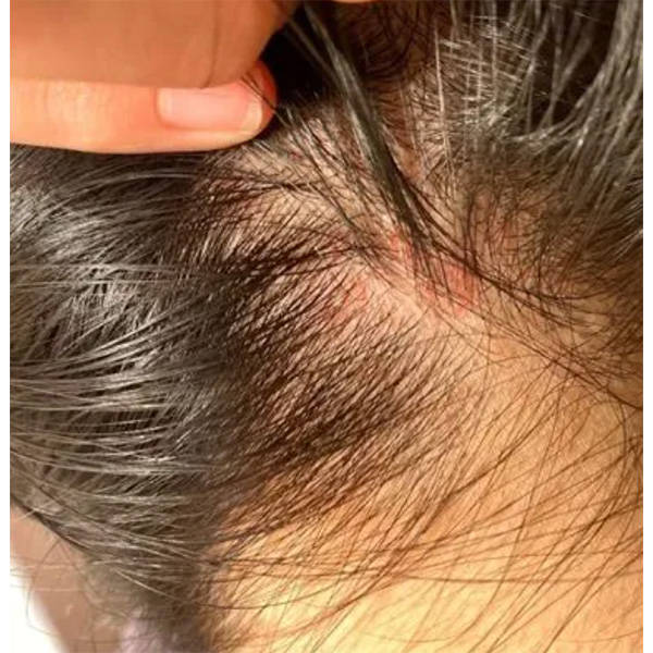 去头屑止痒的洗发水排行榜_头发_头皮屑_问题