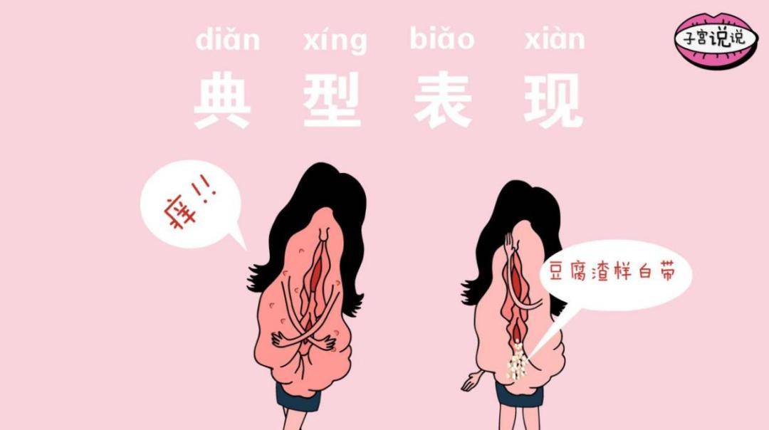 正确治疗,与念珠菌性阴道炎说再见!