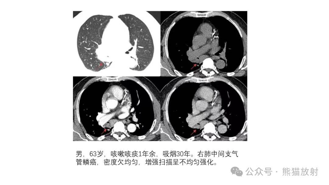 【省立影像读片】气管支气管肿瘤24.02_内容_检索_公众