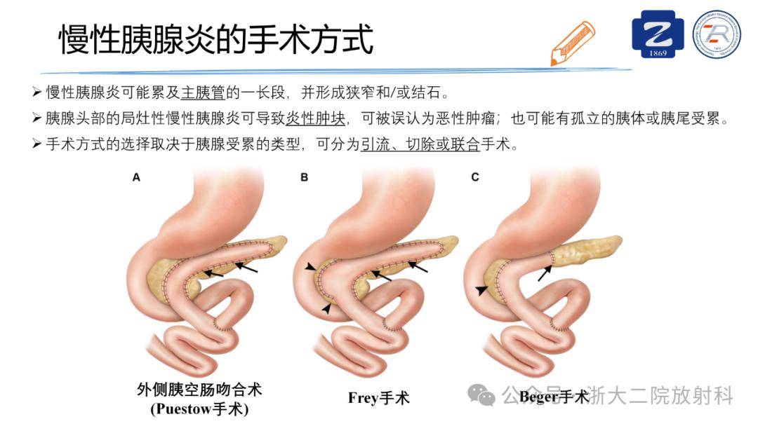 frey手术图片