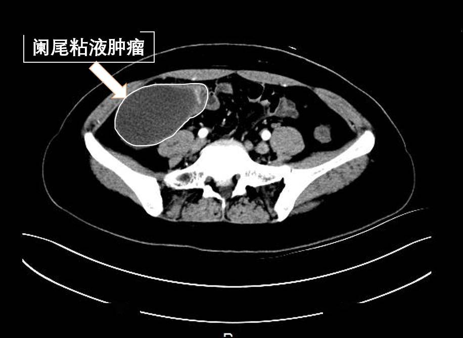 肚子痛了3年误以为阑尾炎