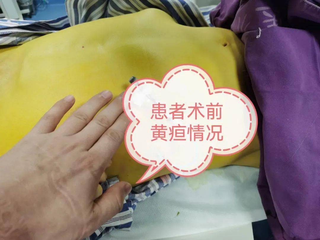 "介"显神通 | 轻松拯救"小黄人":"1"根导管 "0