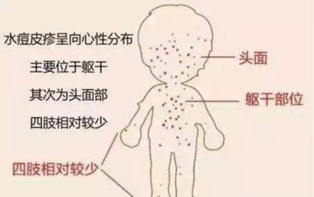 各位家长务必警惕_传播_病毒_水痘