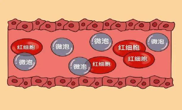 声诺维造影剂图片图片