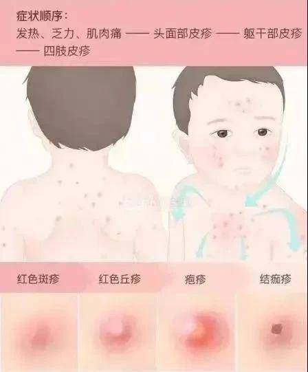 水痘由躯干开始可以波及到发际,口腔黏膜;◆猩红热从颈部上胸部开始