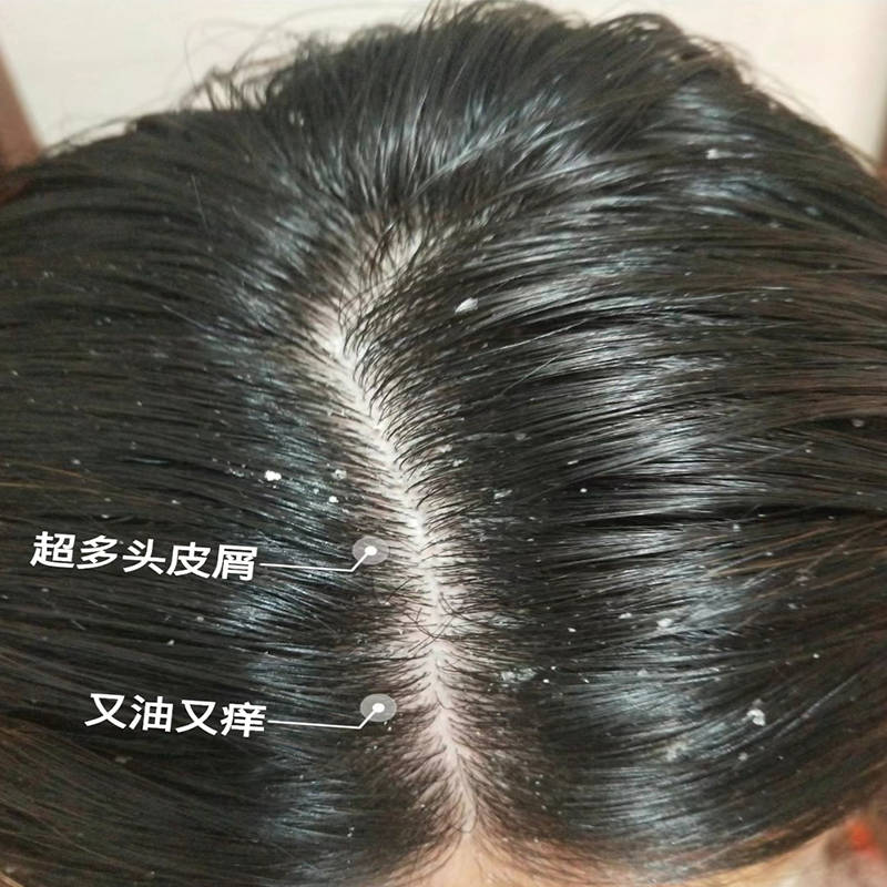 头发出油头皮屑多用什么洗发水?_去屑_问题_产品