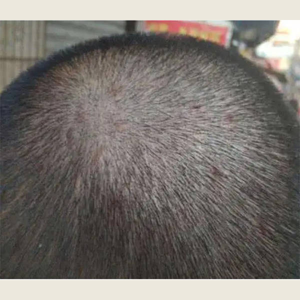 头皮止痒的洗发水推荐_问题_头发_成分