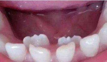 大多数病牙是可以通过补牙,镶牙,牙周病治疗等方法进行挽回的,只有一