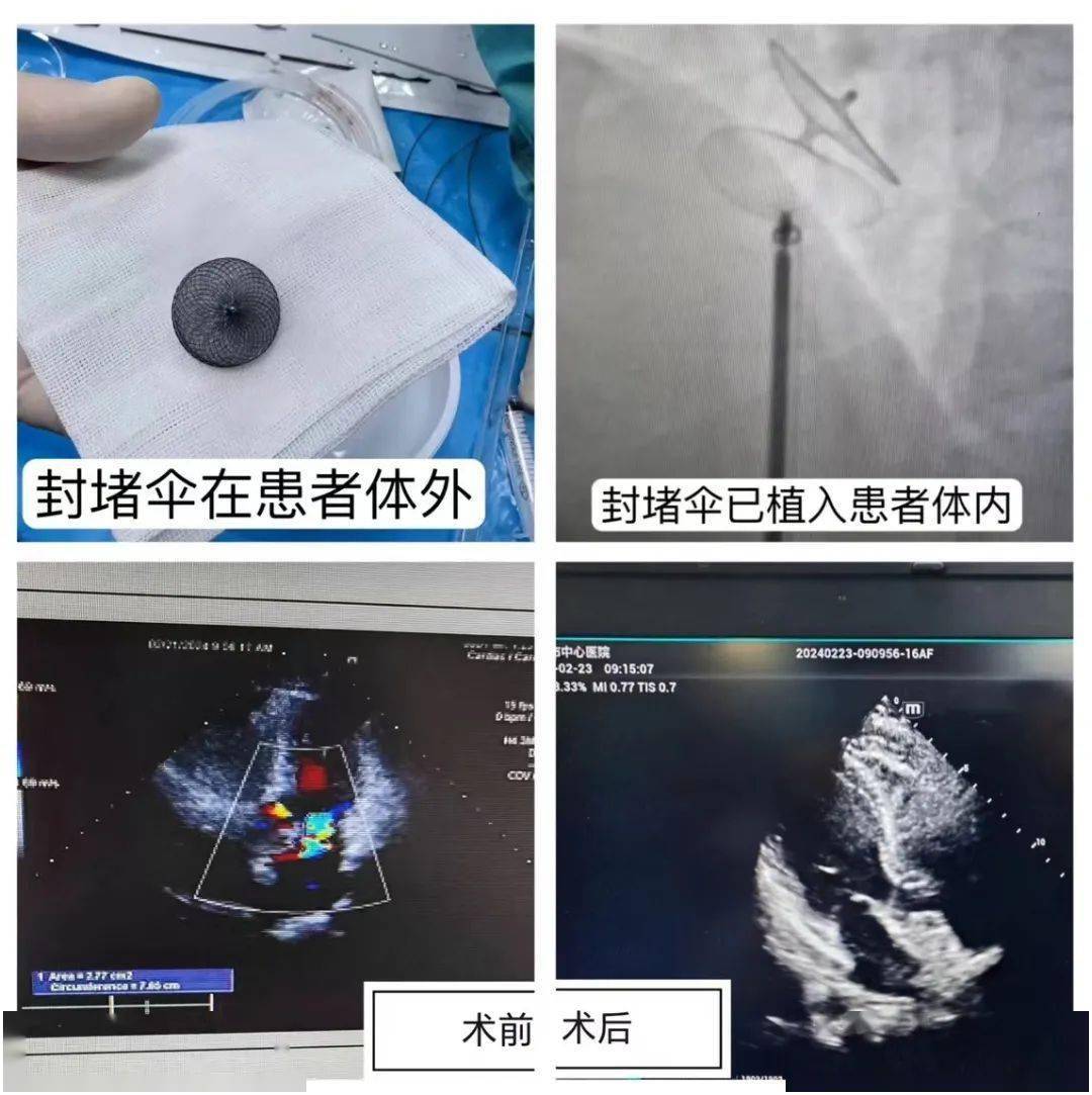 心脏卵圆孔封堵器图片图片