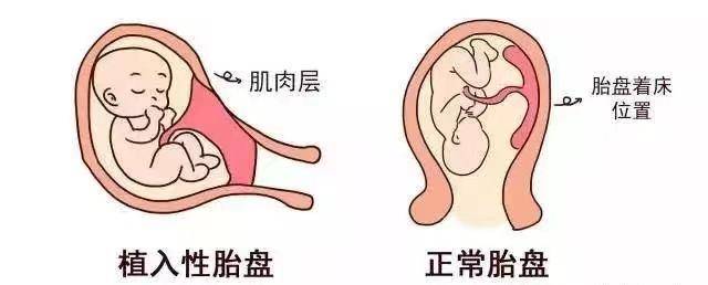 胎盘植入穿透子宫肌层,聚焦超声消融保住了她做妈妈的机会