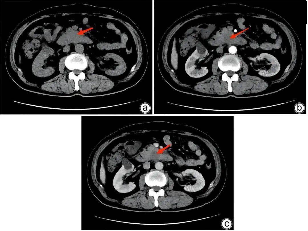 病例报告|胰腺内副脾误诊2例_患者_肿瘤_尾部