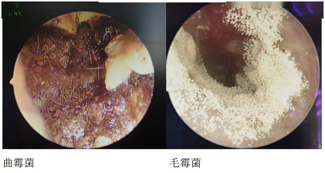 耵聍栓塞是什么意思图片