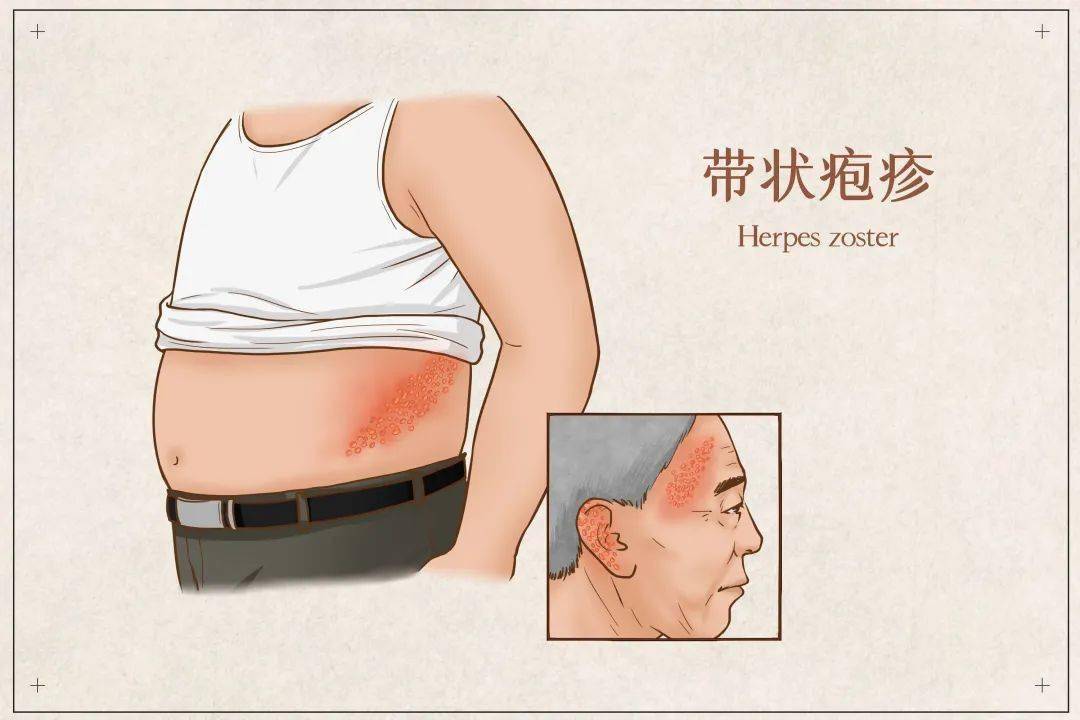 "生蛇","缠腰龙"等,是潜伏于感觉神经节的水痘-带状疱疹病毒再激活后