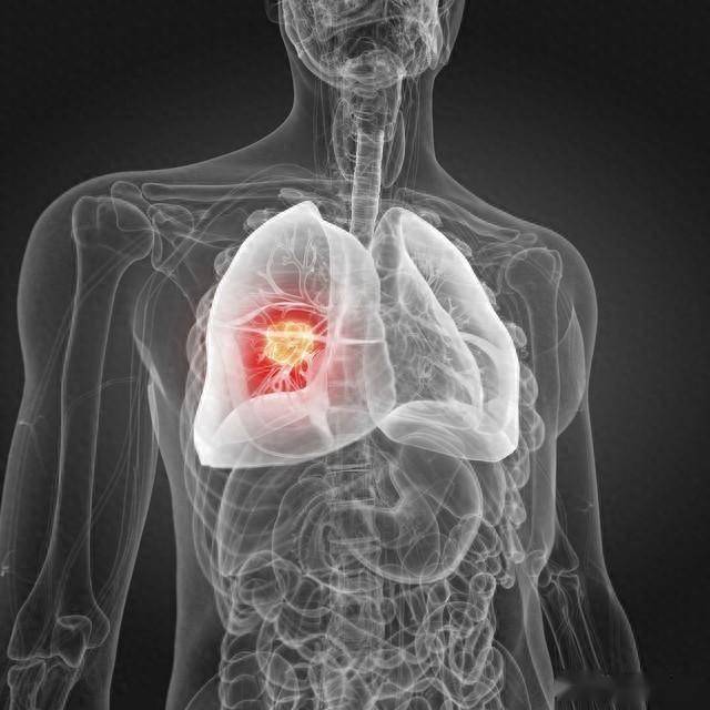 肺癌早期症状图片图片