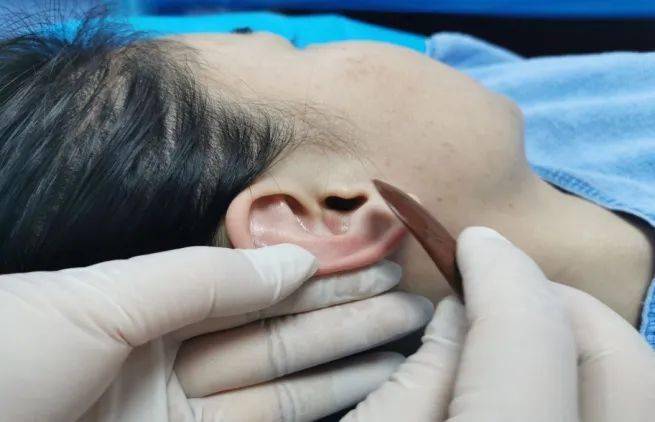 失眠多梦何时休耳部刮痧来帮您