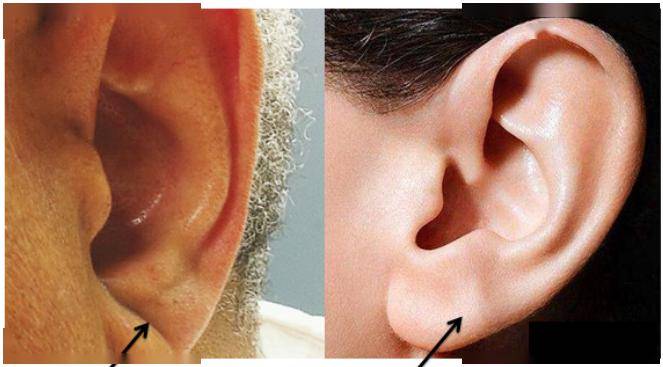 可能存在健康问题_耳垂_皮肤_血管