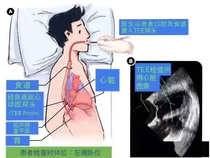 经食道心脏超声图片