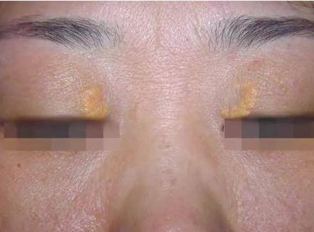 可能存在健康问题_耳垂_皮肤_血管