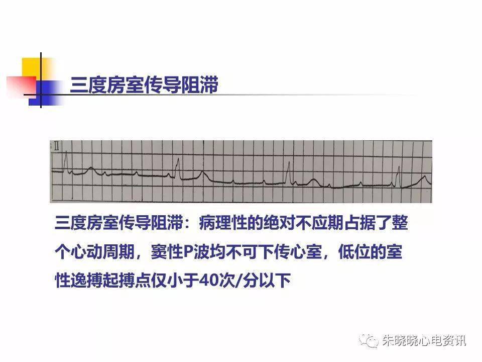 心电图危急值内容图片