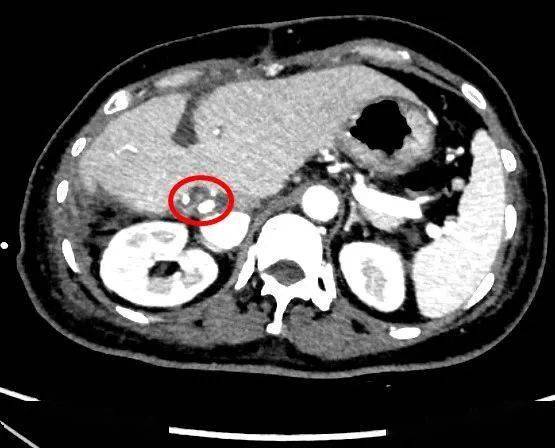重医三院医疗动态妙手回春别平教授团队完成高难度肝门部胆管癌切除术