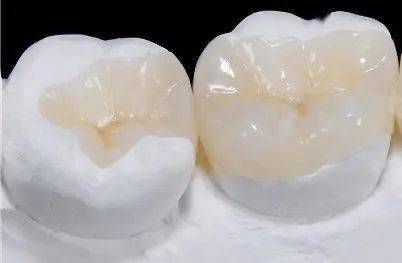 树脂嵌体金属嵌体嵌体是一种嵌入牙体内部,用于恢复牙体缺损的形态和