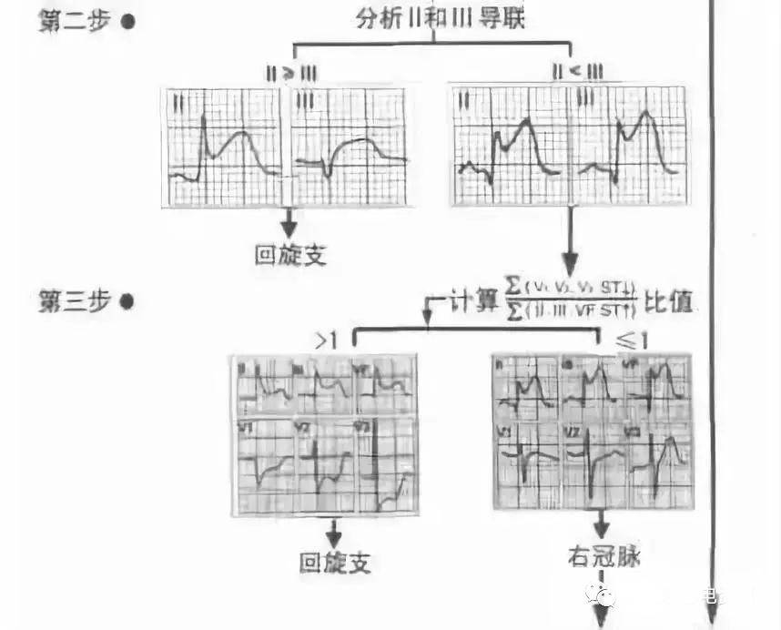 回旋支病变:本壁心电图stii↑>stavf↑>stiii↑;邻壁为高侧壁或前侧壁