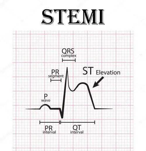 心梗位置判断 图图片