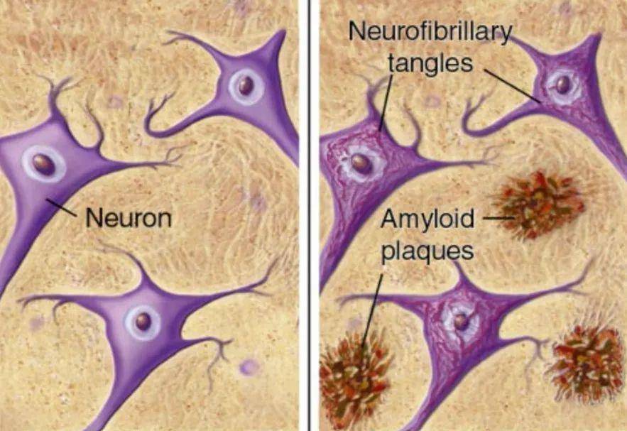 β淀粉样斑块中的β淀粉样单体是一种抗氧化剂,其功能是保护我们大脑