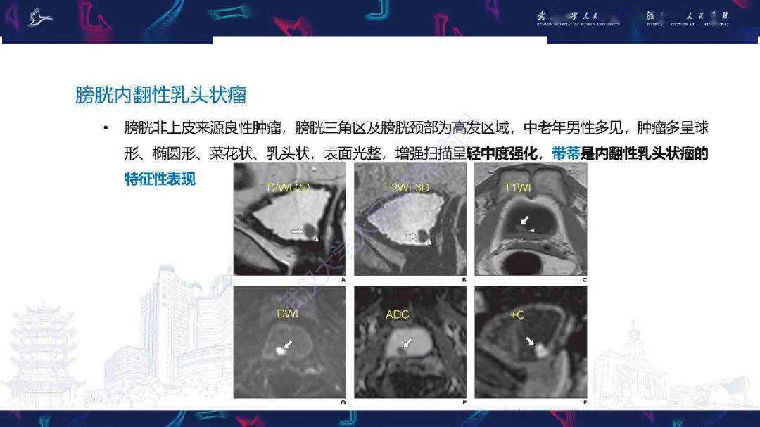 膀胱副神经节瘤影像诊断