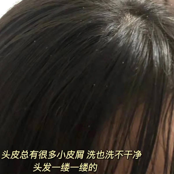 头皮屑_成分_效果