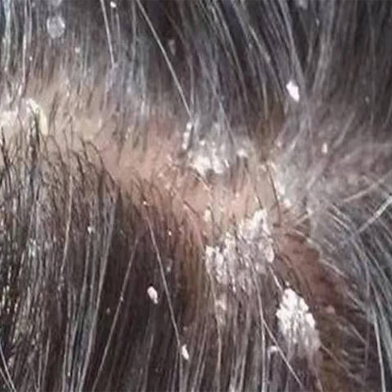 洗发水控油去屑止痒_头皮_头发_问题