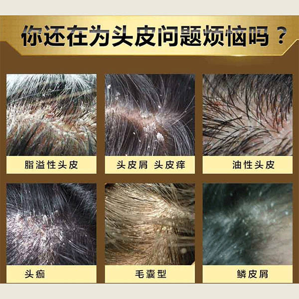 头皮_去屑_头发