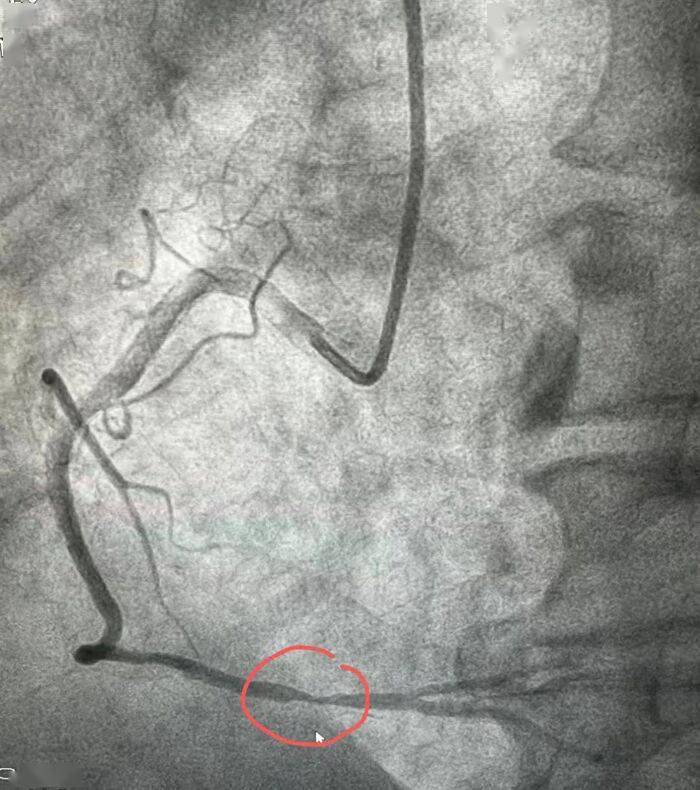 血管造影,造影发现脑血管病变比心脏更为严重,双侧椎动脉中左侧为闭塞