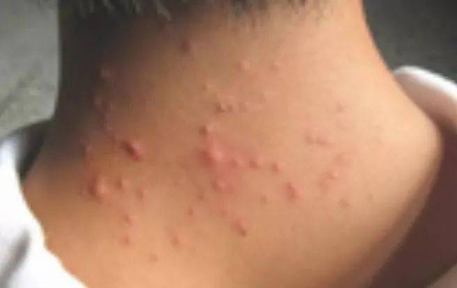 脖子上的小肉粒说明身体这里出了问题一定要注意