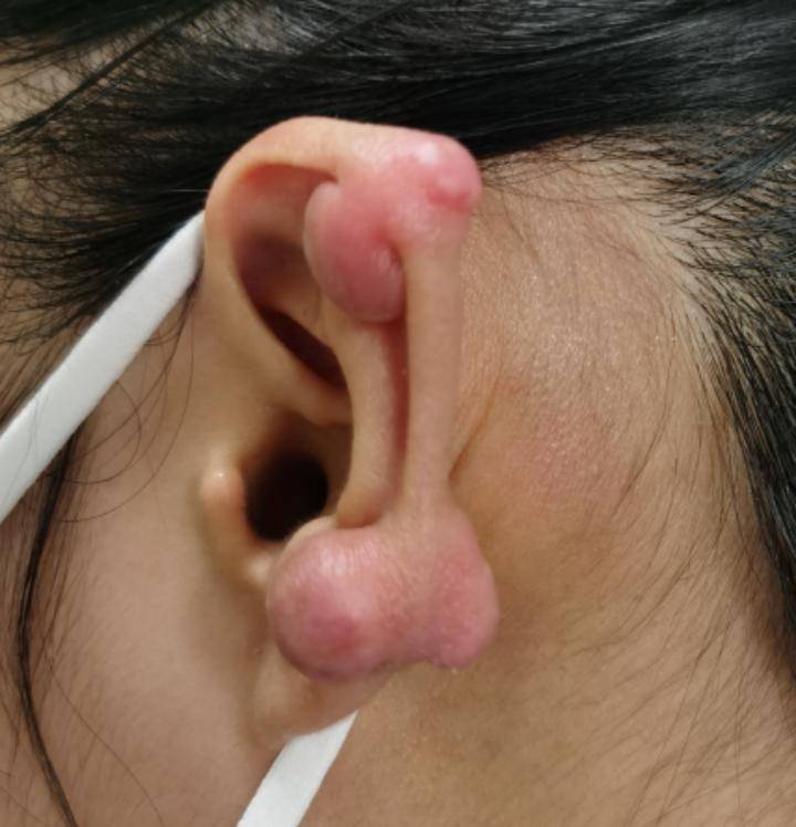 打耳洞后长了个肉疙瘩医生提醒这种体质的人要当心
