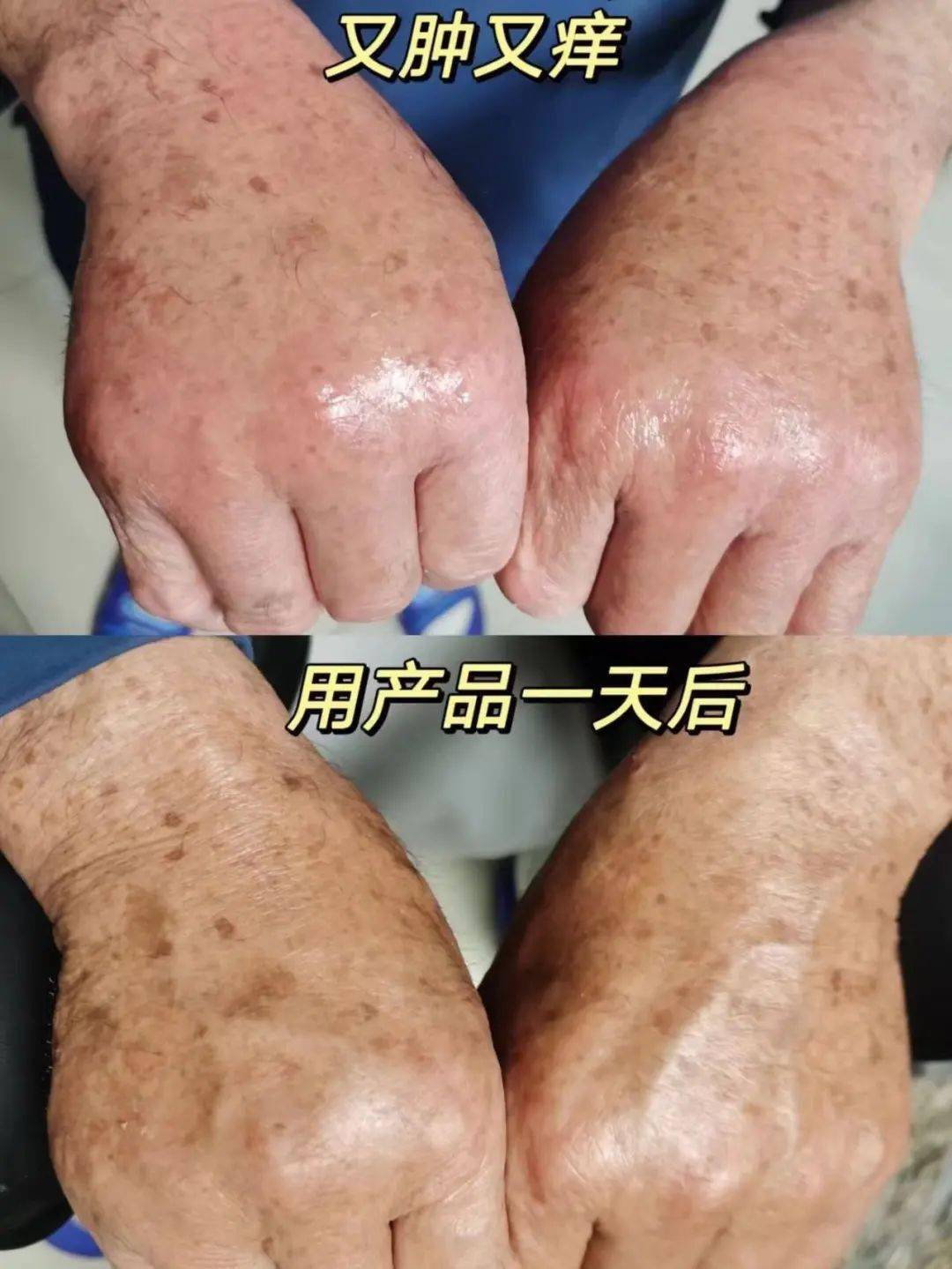 4折清仓:荨麻疹,湿疹,敏宝,追身高路上的神助攻_海得宝_男友_凝胶