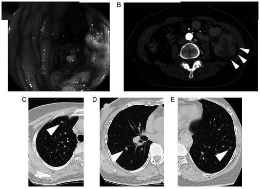岂有此例丨dfs超过5年首个单中心转移性晚期结直肠癌系列病例分享