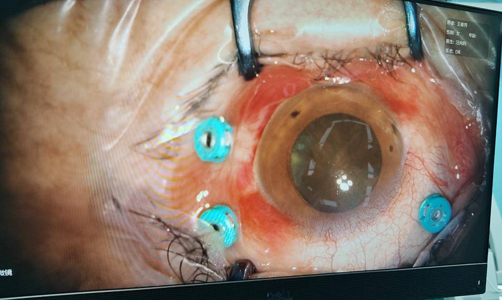 重见光明省二院眼科成功开展首例玻璃体切除术