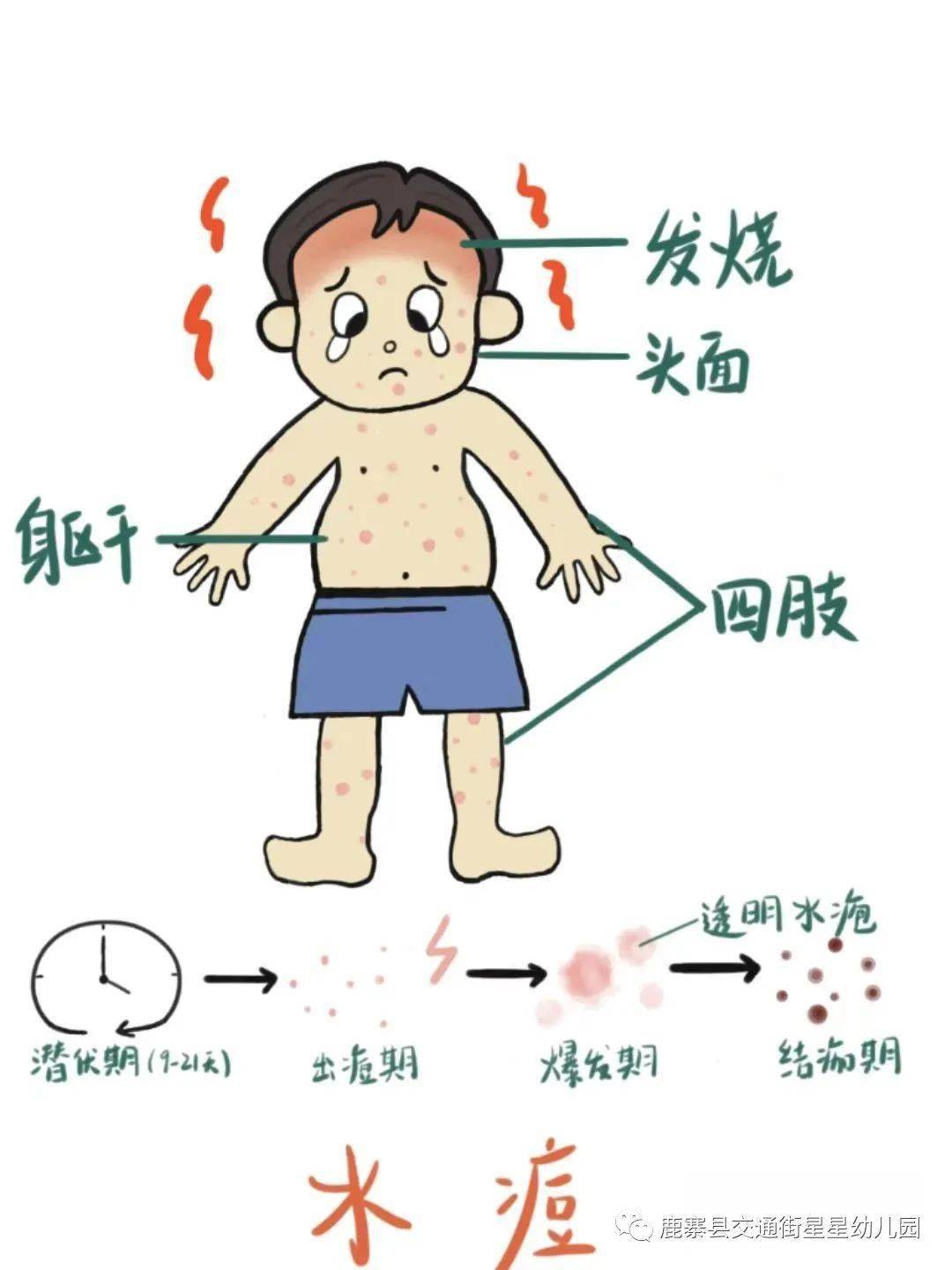 预防水痘卡通图片