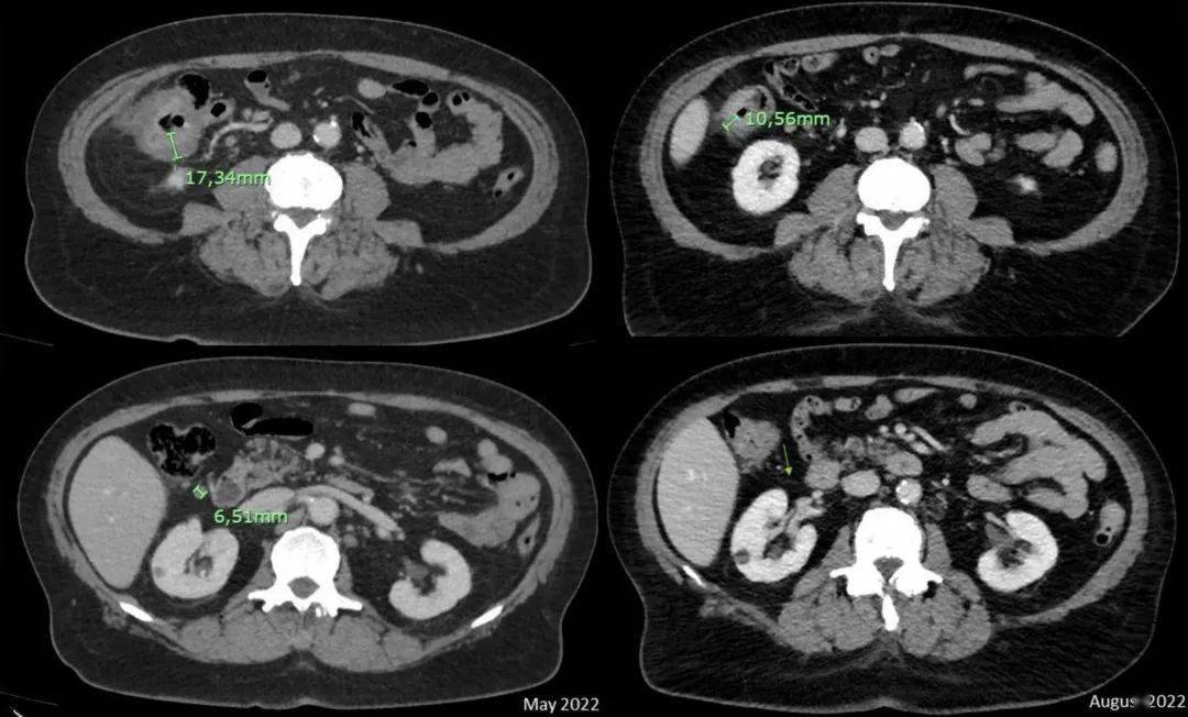 新辅助免疫治疗在 dmmr/msi-h 结直肠癌转化治疗中的疗效如何?