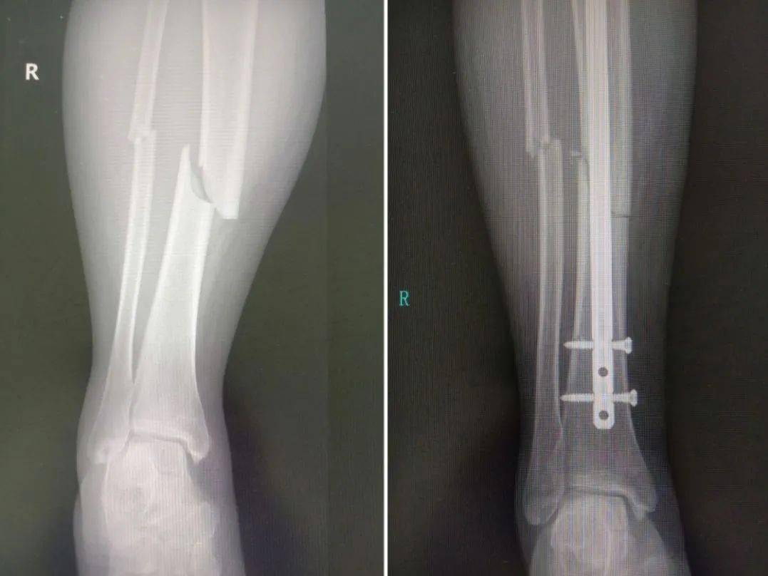 宝应张女士被铲车铲伤._手术_患者_断肢