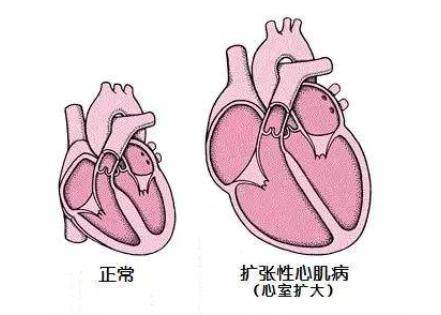 扩张型心肌病以心室扩大,心室收缩功能降低为特征,在我国的发病率为