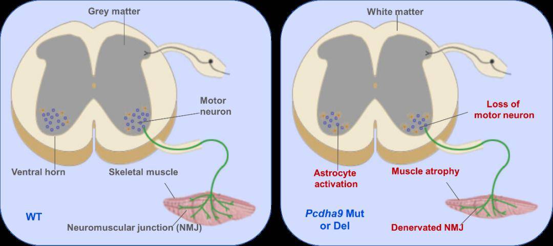 肌萎缩侧索硬化症(als)是一种常见的神经退行性疾病,其发病原因和机制