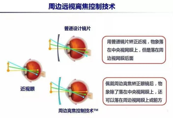 戴镜度数还在涨?离焦眼镜帮你忙