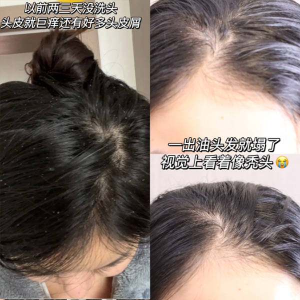 洗发去屑控油止痒?_头发_头皮屑_问题