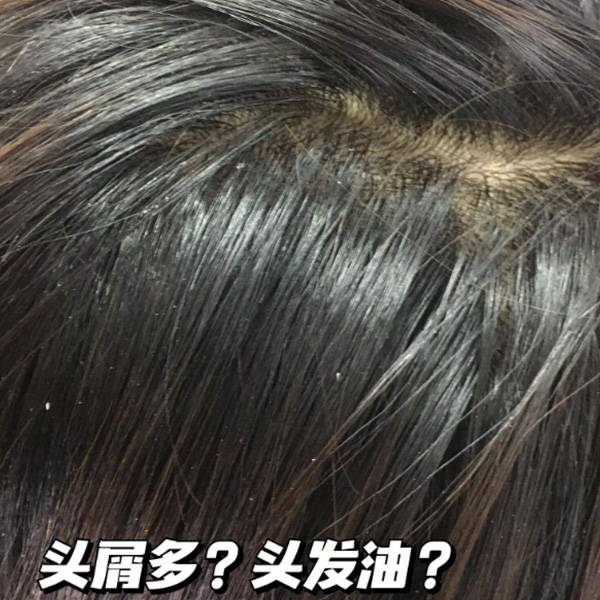 头皮屑通常是由于表皮细胞的异常脱落,这可能由于头皮干燥,皮脂分泌过