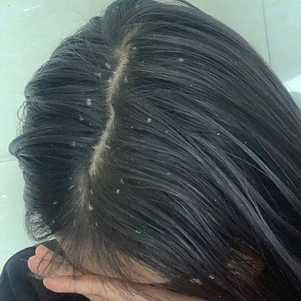 二硫化硒洗发水真的有用吗去屑止痒控油的洗发水推荐